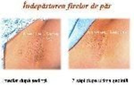 Epilare DefinitivaIPL: 5sedinte+1gratis, consult GRATIS Epilare DefinitivaIPL: 5sedinte+1gratis, consult GRATIS