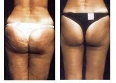 Masaj anticelulitic cu aparatul LPG Cellu M6