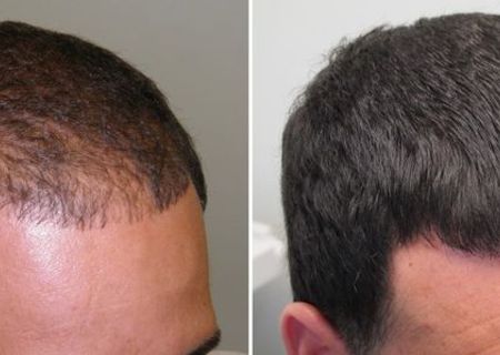 NU lasa caderea parului sa te afecteze!regenerare cu Minoxidil 5% Kirkland