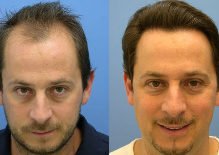 SPUMA /FOAM Minoxidil 5% Kirkland SUA impotriva caderii parului