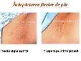 Epilare DefinitivaIPL: 5sedinte+1gratis, consult GRATIS
